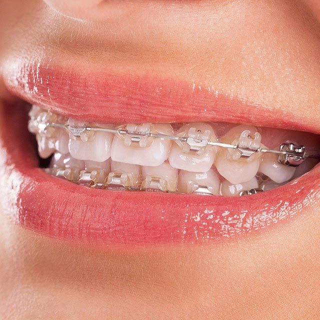 Sonrisa con tratamiento de ortodoncia