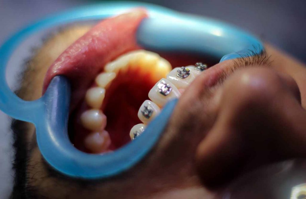 Tratamiento de ortodoncia en proceso