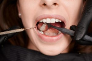 tratamiento para combatir la piorrea dental