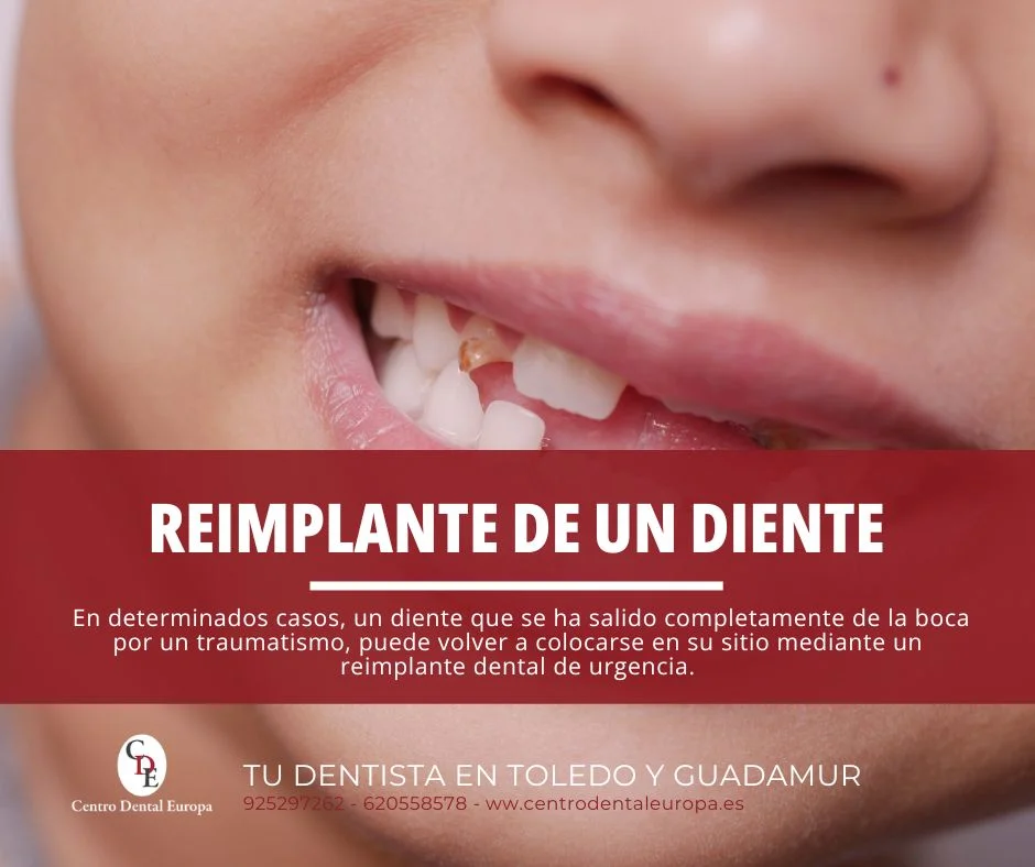 reimplantar un diente